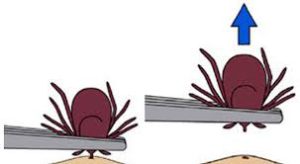 Image showing two steps of proper removal of a tick using tweezers