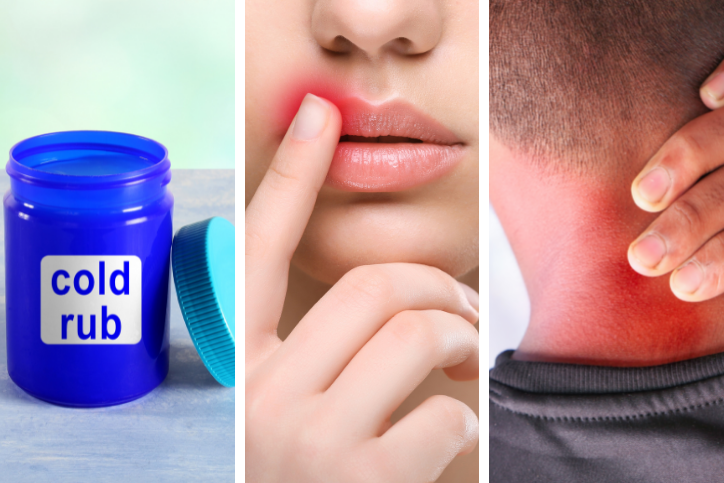 A collage of three photos- container of cold rub, woman pointing to cold sore on lip, and a man holding the back of his neck